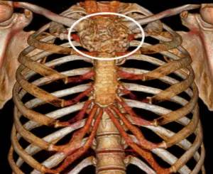 第四軍醫(yī)大學(xué)精彩分享個(gè)性化醫(yī)療3D打印的實(shí)戰(zhàn)案例與研究成果 第四軍醫(yī)大學(xué)精彩分享個(gè)性化醫(yī)療3D打印的實(shí)戰(zhàn)案例與研究成果