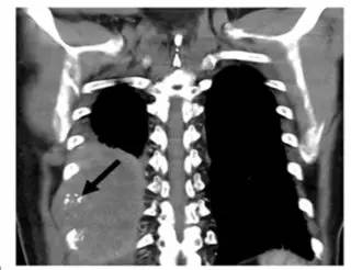 第四軍醫(yī)大學(xué)精彩分享個(gè)性化醫(yī)療3D打印的實(shí)戰(zhàn)案例與研究成果 第四軍醫(yī)大學(xué)精彩分享個(gè)性化醫(yī)療3D打印的實(shí)戰(zhàn)案例與研究成果