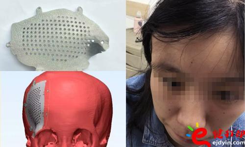 醫療3d打印應用,醫用3d打印,3D打印假肢,3D打印脊椎,3D打印心臟,e鍵打印,3d打印服務 3D打印的顱骨假體，非常適用于發際外的顱骨缺損、病變置換，將使患者的面容恢復到正常形態，完美解決了傳統顱骨修補存在的美容問題。據悉，3D打印個性化顱骨假體修補技術已獲國家重點研發計劃資助，能為一批病人免費提供假體，并能減免一些檢查和治療費用。未來將實行72小時的3D假體個性化顱骨修補術，造福更多的患者。